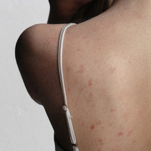 women with backne without post-inflammatory hyperpigmentation