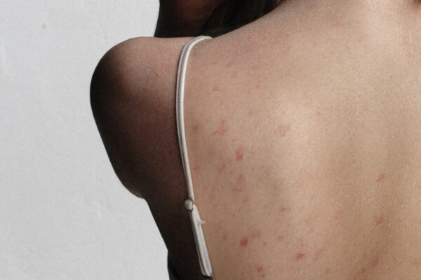 women with backne without post-inflammatory hyperpigmentation