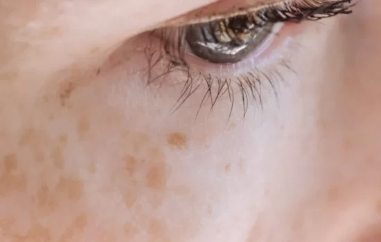 Melasma-Closeup