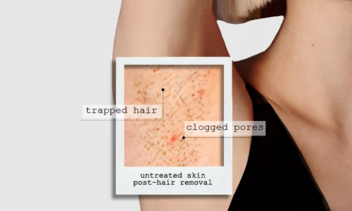ingrown bar_post hair removal trouble updated on aug1 copy