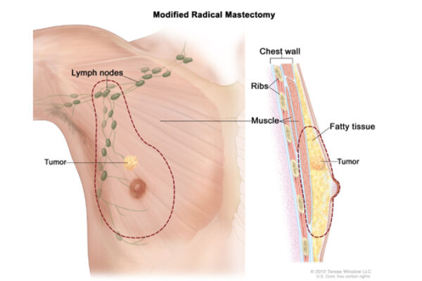 lymph nodes are indicators for armpit lumps