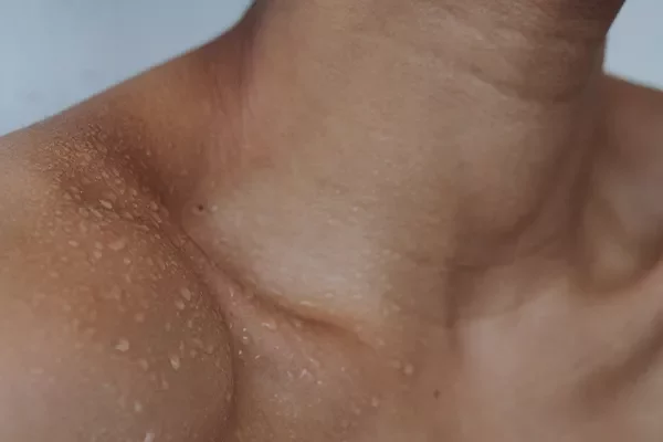 moisture - itchy armpits