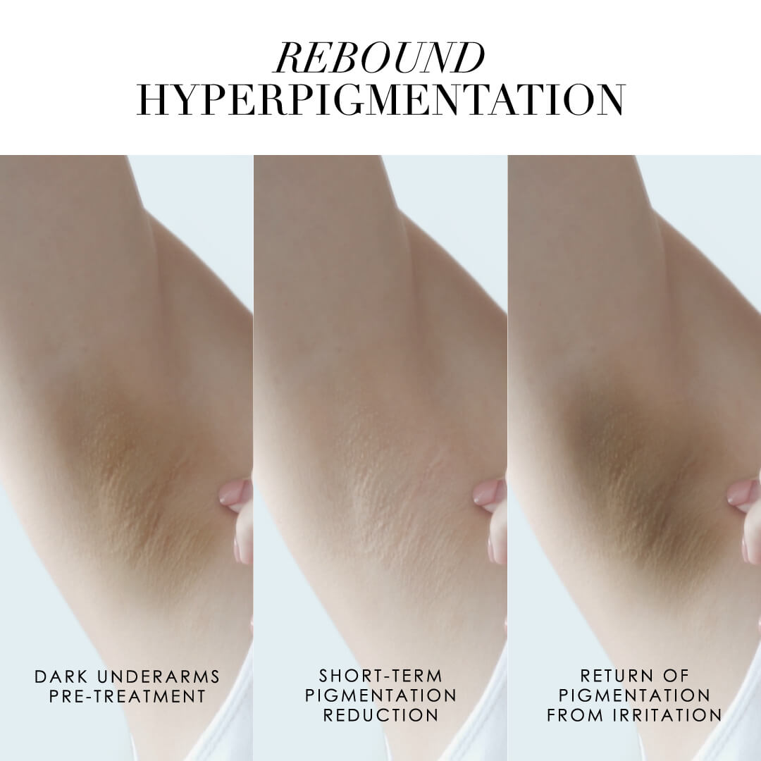 rebound hyperpigmentation